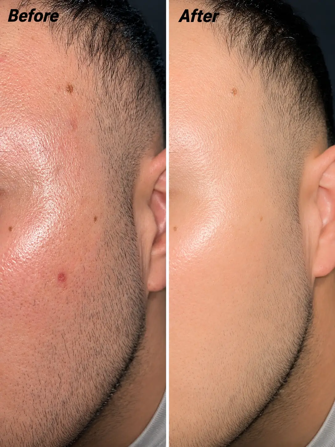 Microneedling Derma Stamp 140 Needles - Adjustable Titanium Tool | VALÉNCIA