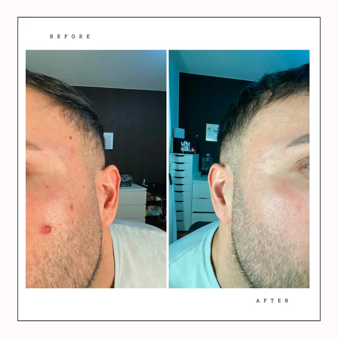 Men's facial skin close-up, before-and-after showing reduced redness on cheek